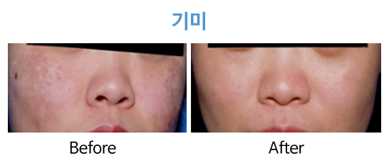 청담연세피부과 기미