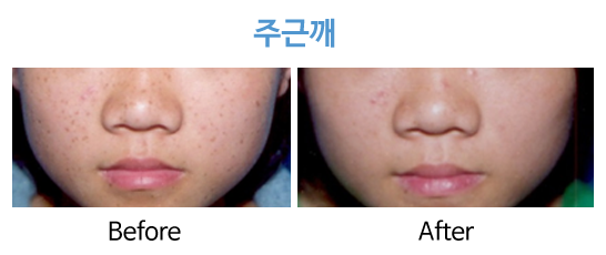 청담연세피부과 주근깨
