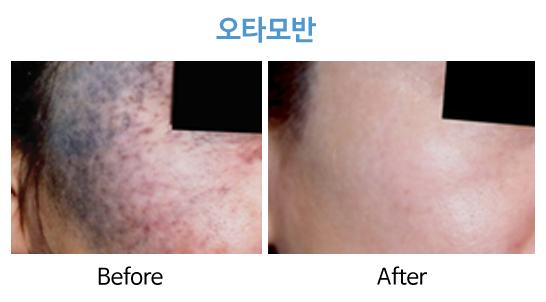 청담연세피부과 오타모반