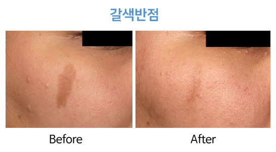 청담연세피부과 갈색반점